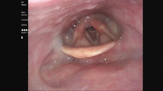 Normal Larynx