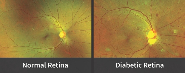 Normal retina v. diabetic retina images