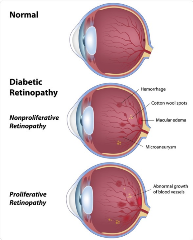 Diabetic retinopathy comparison graphic of normal retina vs DR
