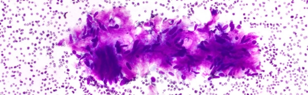 photo of a pathology histogram image