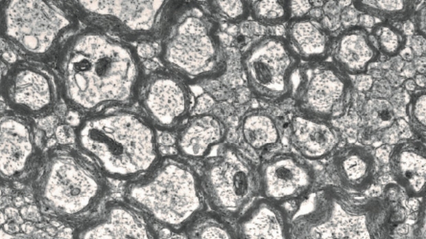 electron micrographs showing myelinated axons from the brains of mice with seizures (Scn8a+/mut) 