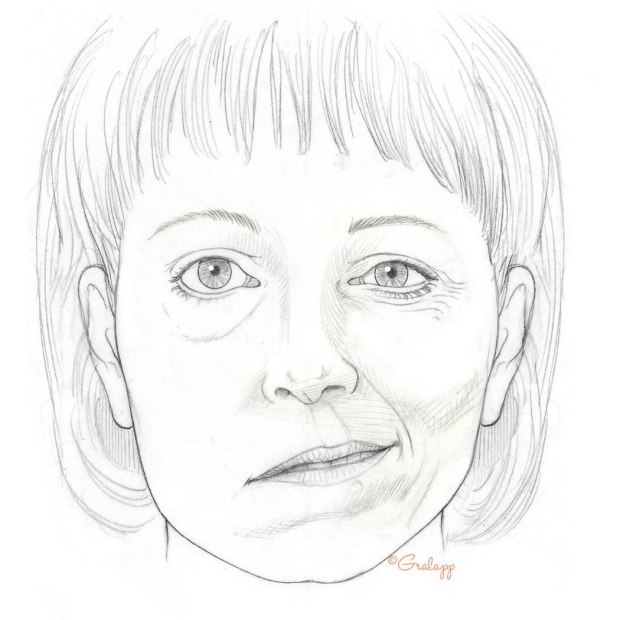 facial paralysis illustration