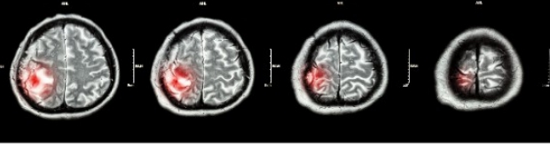 Prolo Lab Brain Tumor Images