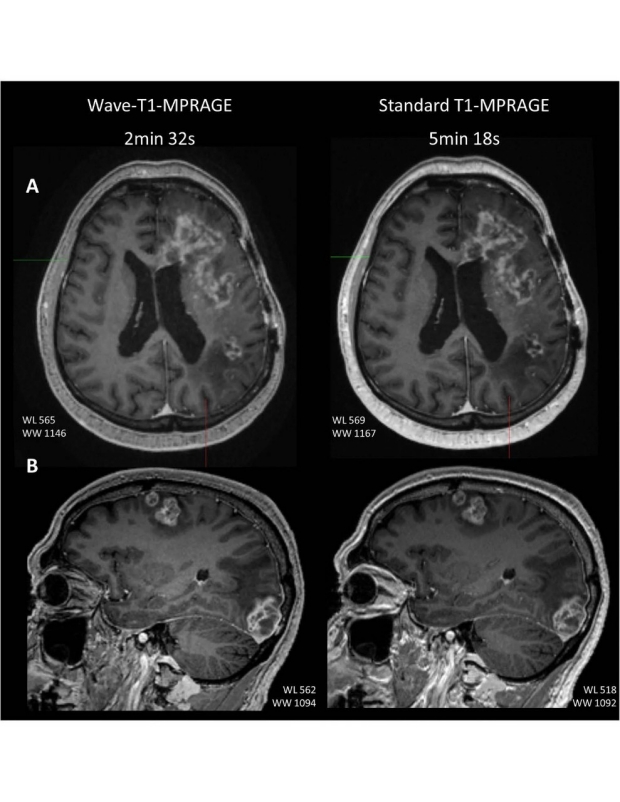 Validation of a highly accelerated post-contrast wave-controlled aliasing in parallel imaging (CAIPI) 3D-T1 MPRAGE compared to standard 3D-T1 MPRAGE for detection of intracranial enhancing lesions on 3-T MRI - European Radiology