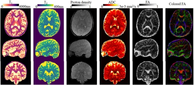 DTI‐MR fingerprinting for rapid high‐resolution whole‐brain T1, T2, proton density, ADC, and fractional anisotropy mapping