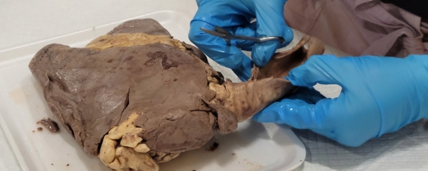 Heart-Lung Dissection