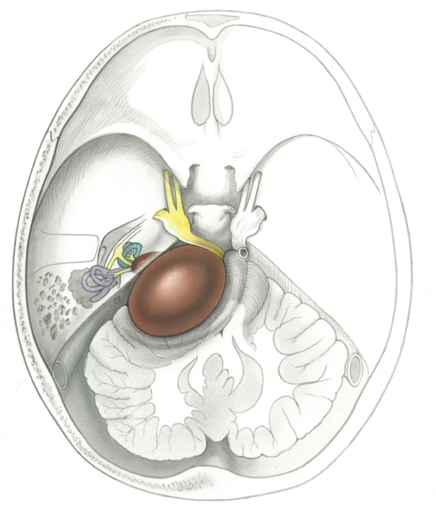 illustration of large skullbase tumor