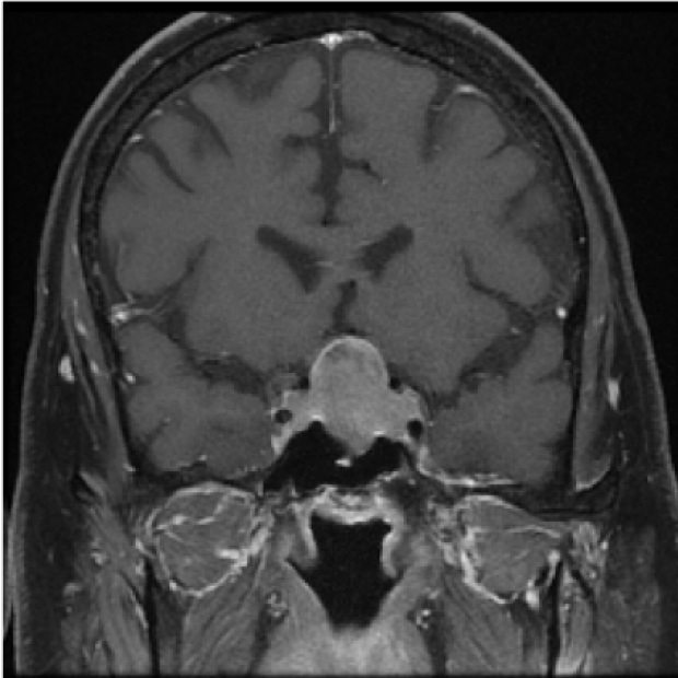 MRI image of Cushing's Syndrome