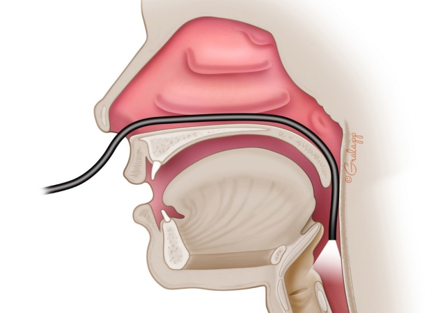 Illustration for endoscopic evaluation