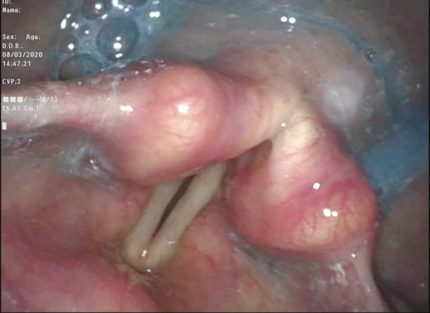 Endoscopic Evaluation of Swallowing showing larynx in color