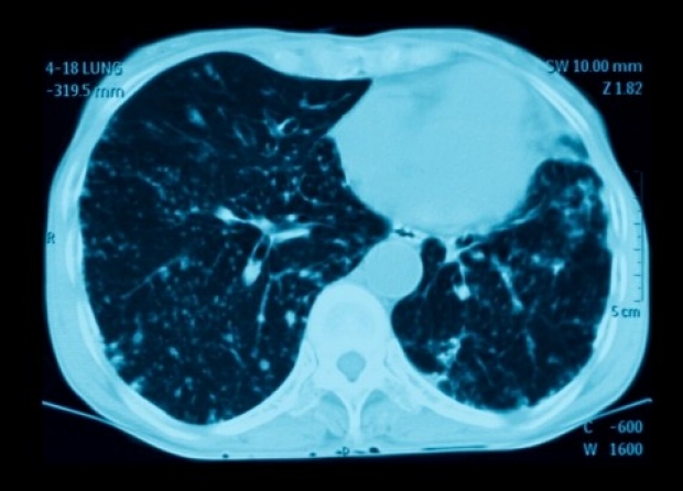 Lung Cancer Screening Guidelines Perpetuate Racial Disparities, Stanford-Led Study Finds
