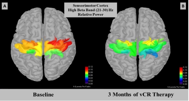This figure displays relative power for the high beta band (21-30 Hz) in the sensorimotor region which comprises the primary sensory and primary motor cortex.