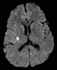 Image showing DWI positivie lesion